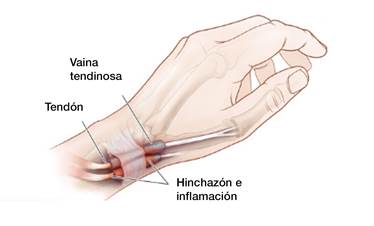 Tenosinovitis o tendinitis de De Quervain