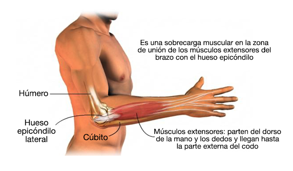 lesiones que puede tener el codo