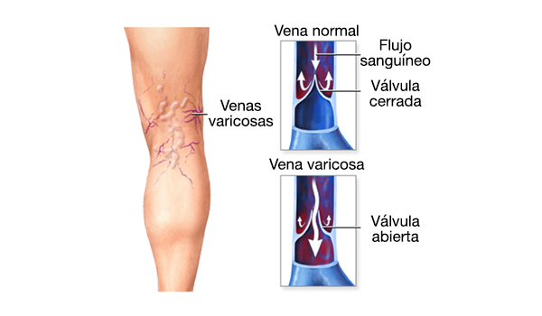 piernas con varices dibujo